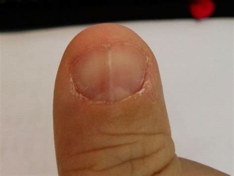 指甲裂痕缺什麼